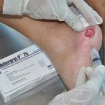 Aplican en Ciego de Ávila estrategia para salvar pies diabéticos